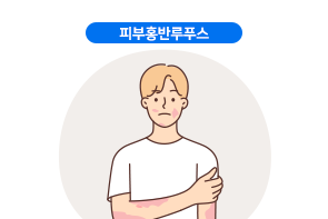 피부홍반루푸스